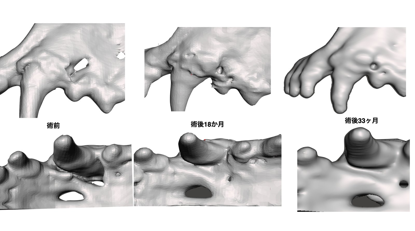 術後33ヶ月までの変化